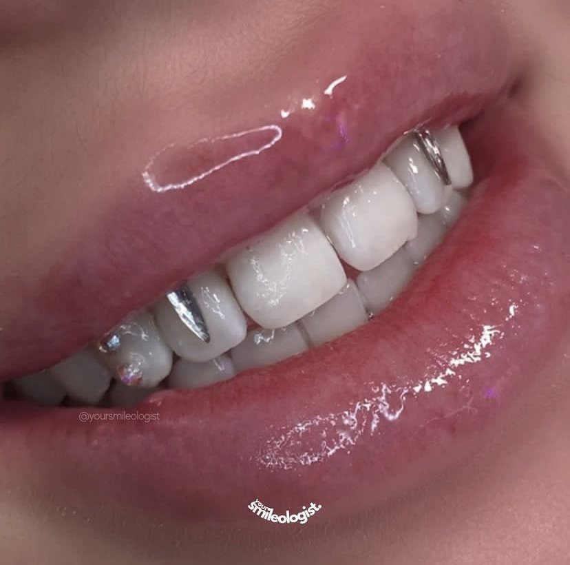 Real tooth gem — single glossy placement