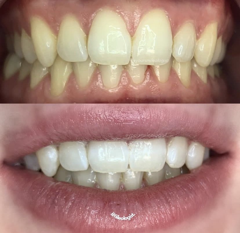 A before-and-after whitening comparison photographed at the studio.
