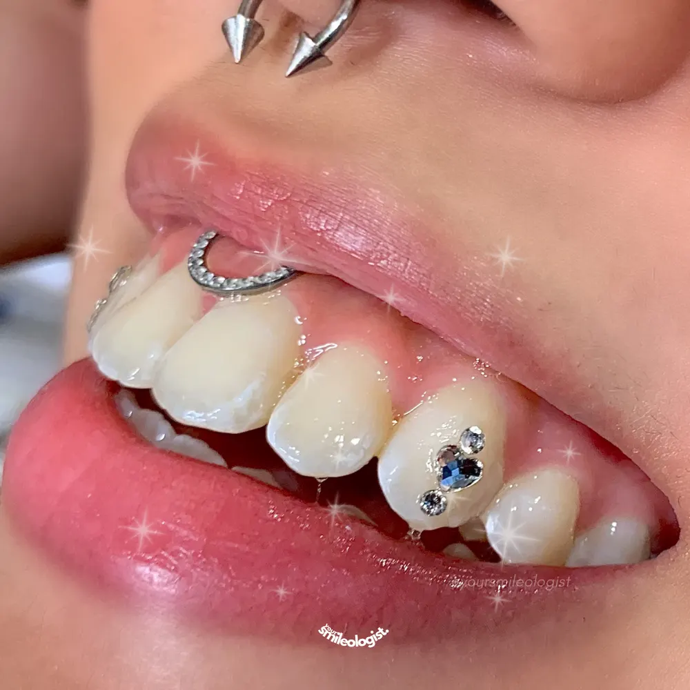 Tooth gem placement by Nhi, client work 1