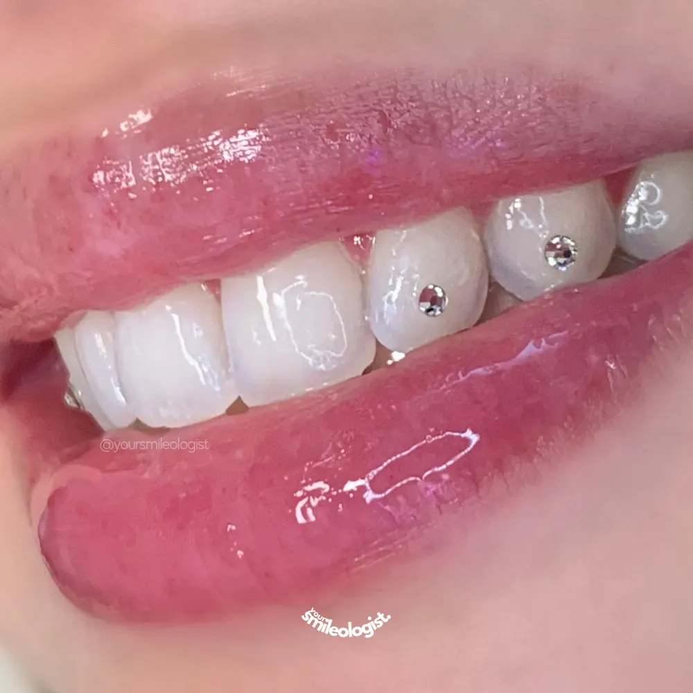 Tooth gem placement by Nhi, client work 2