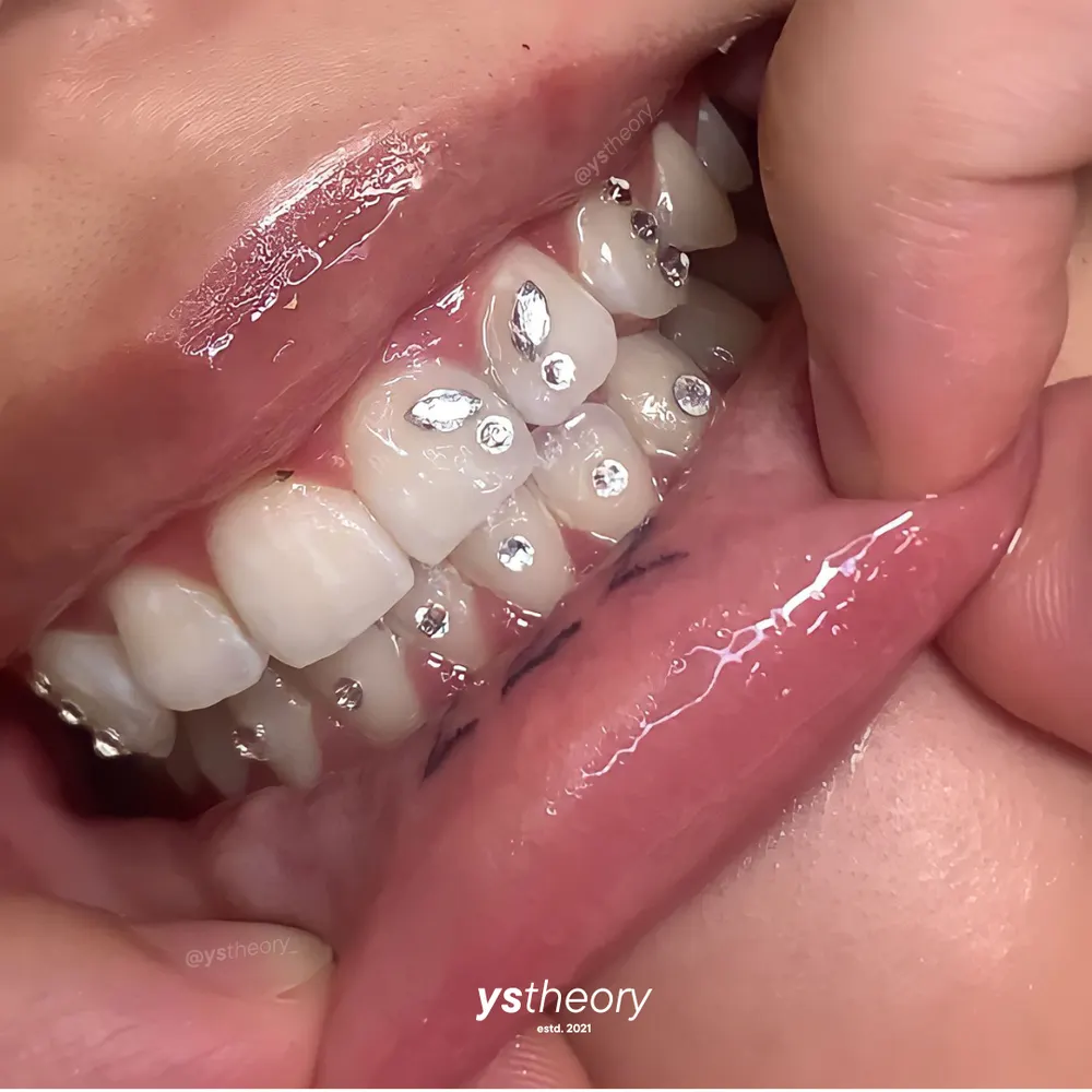 Tooth gem placement by Nhi, client work 4