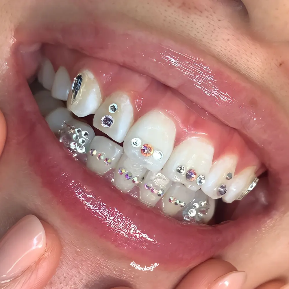 Tooth gem placement by Nhi, client work 6