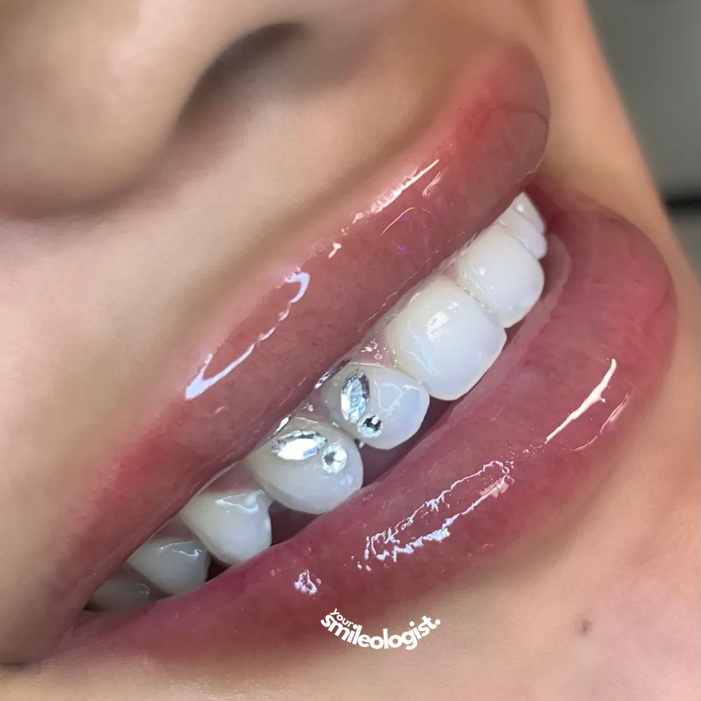 Tooth gem placement by Nhi, client work 11