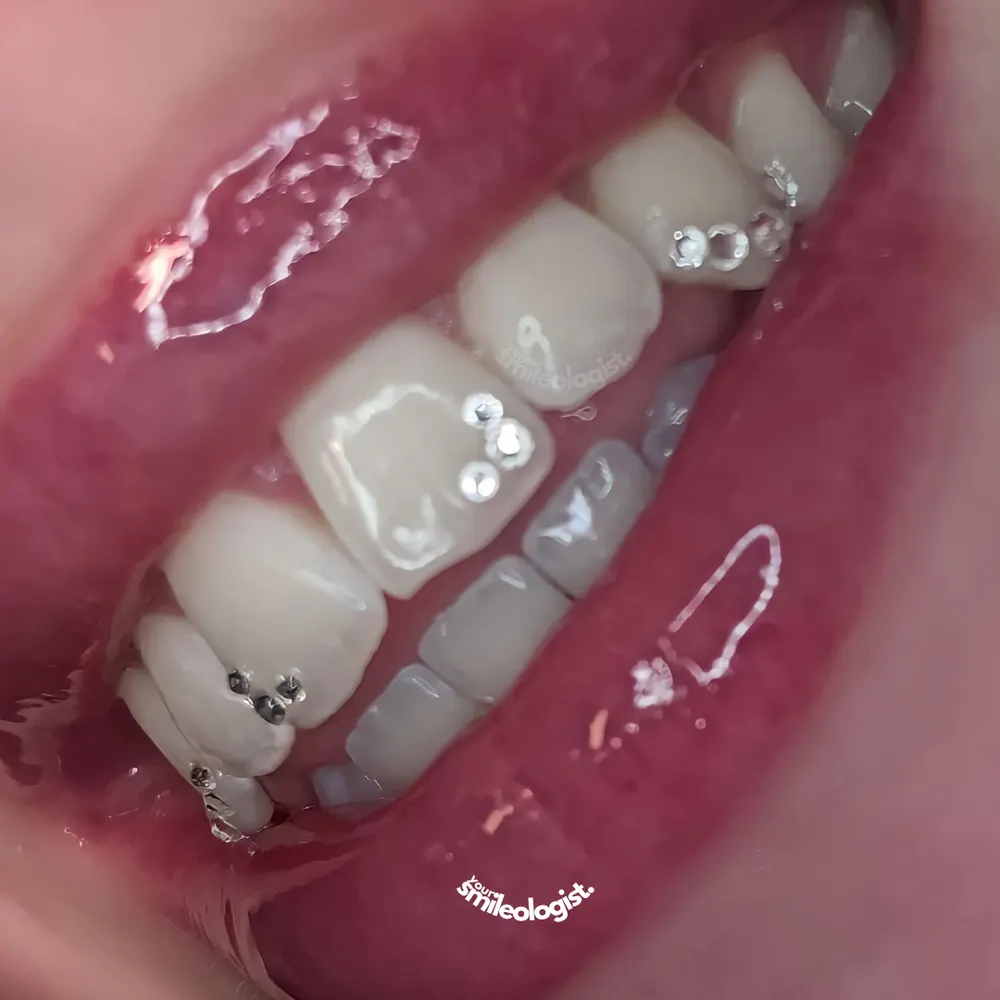 Tooth gem placement by Nhi, client work 12