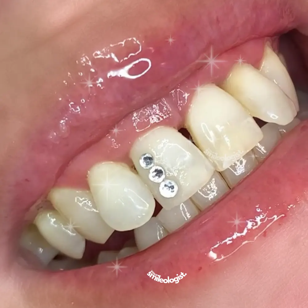 Tooth gem placement by Nhi, client work 14