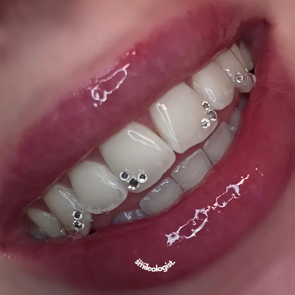 Tooth gem placement by Nhi, client work 21