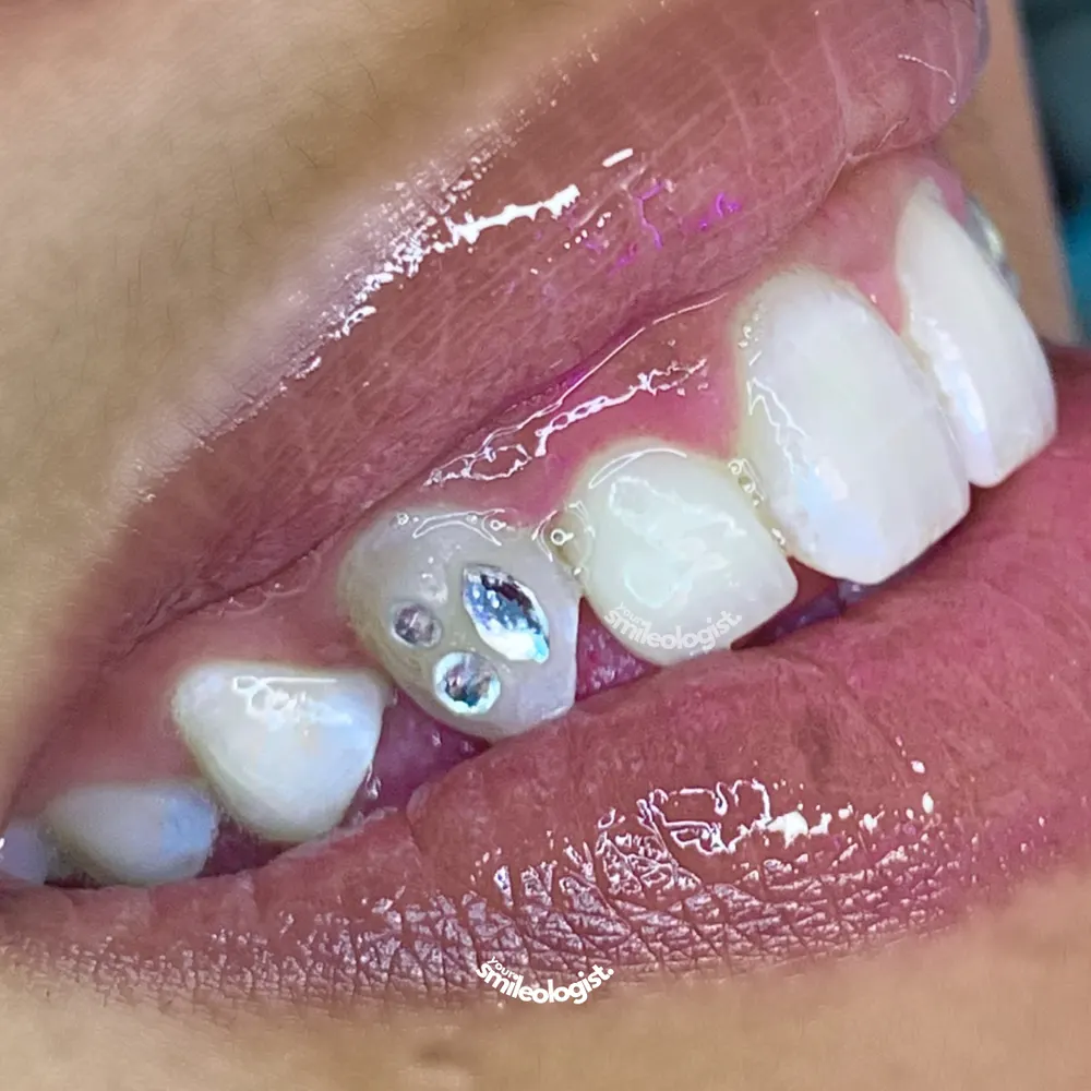 Tooth gem placement by Nhi, client work 22