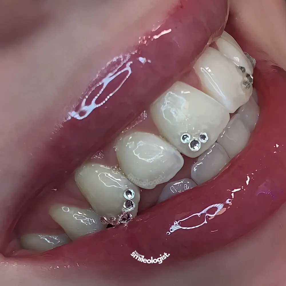 Tooth gem placement by Nhi, client work 26