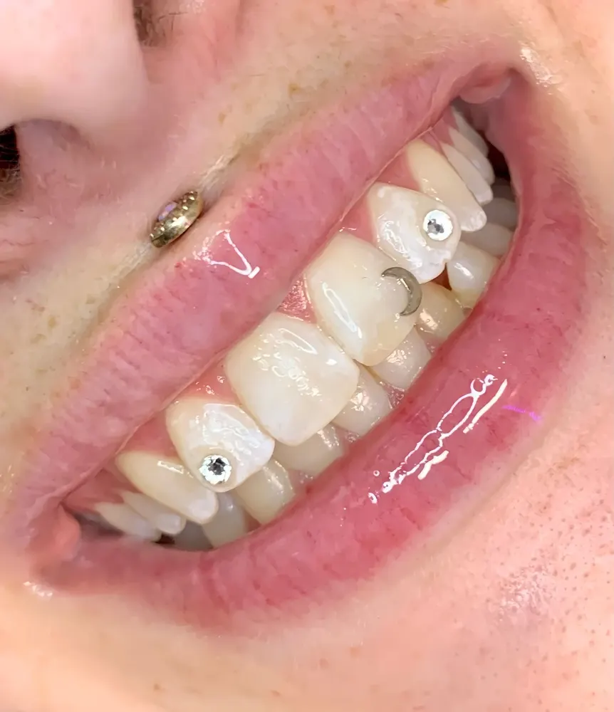 Tooth gem placement by Nhi, client work 27