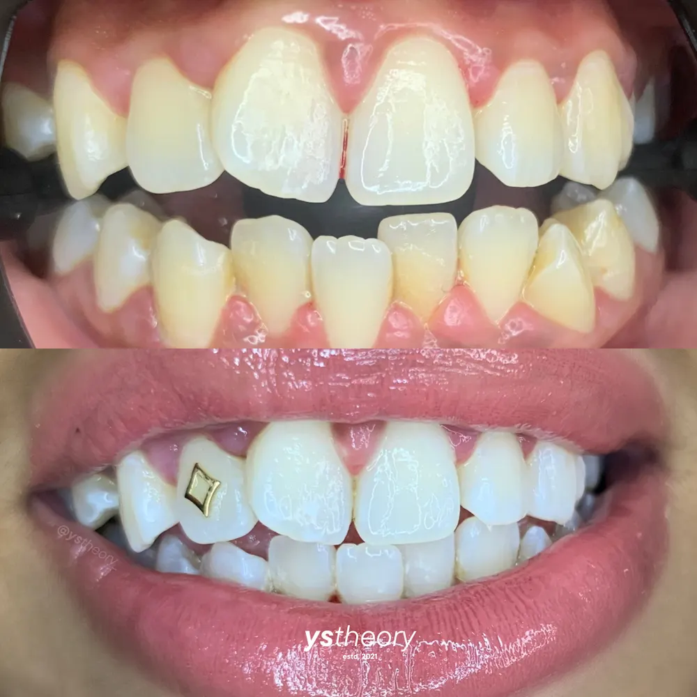 Tooth gem placement by Nhi, client work 29