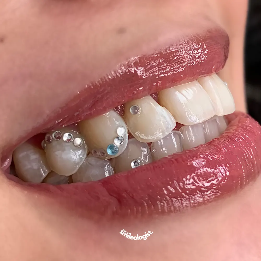 Tooth gem placement by Nhi, client work 30