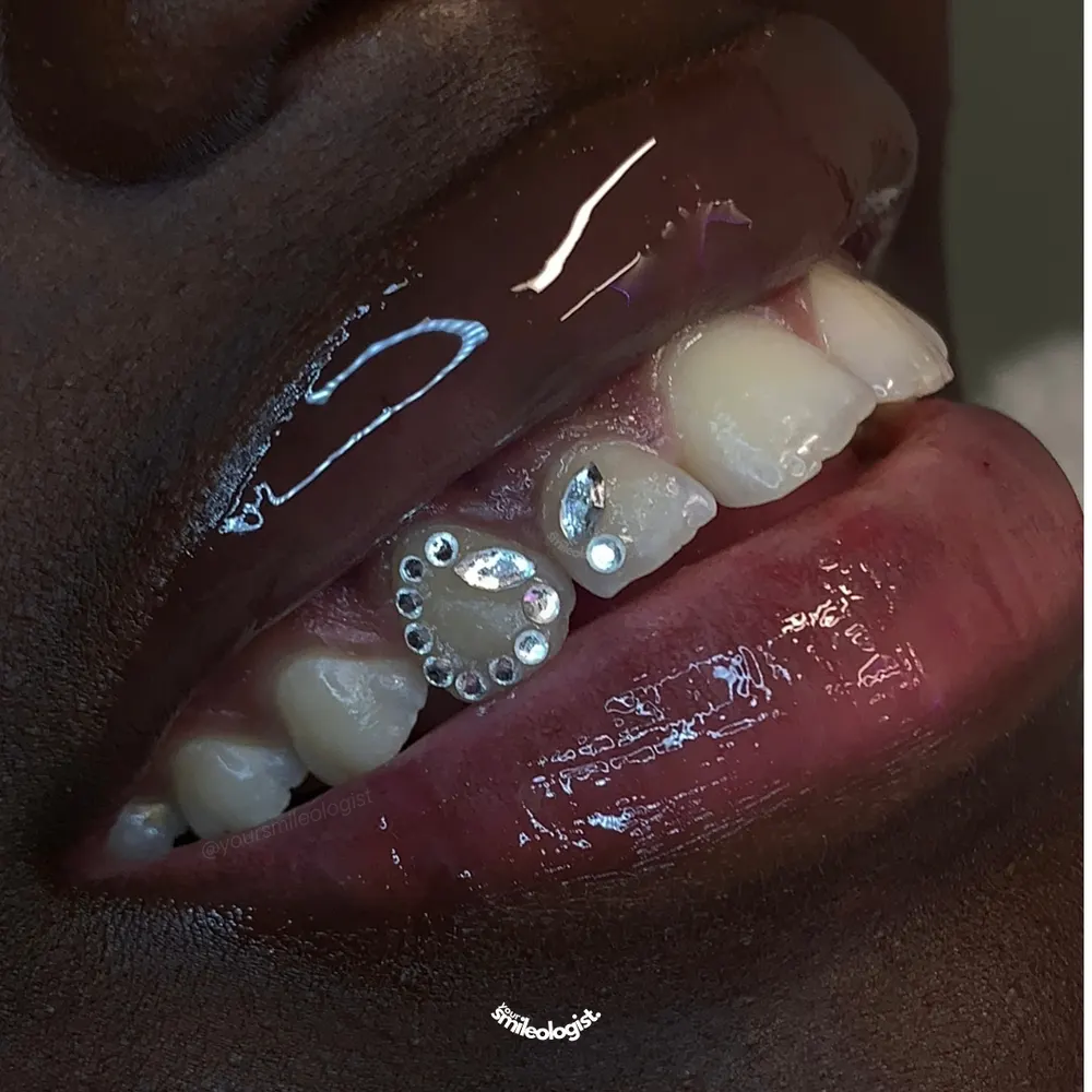 Tooth gem placement by Nhi, client work 32