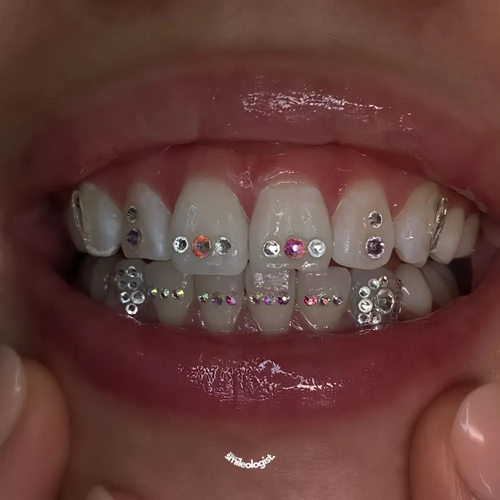 Tooth gem placement by Nhi, client work 34
