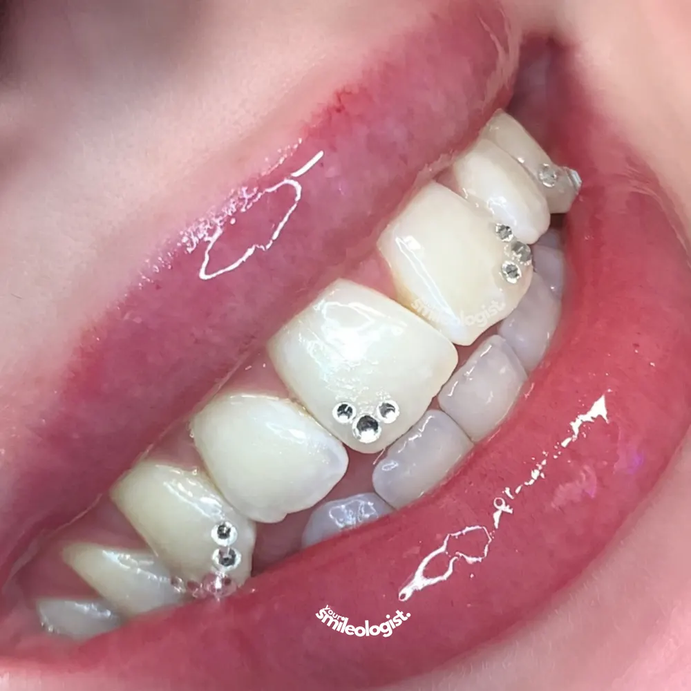 Tooth gem placement by Nhi, client work 38