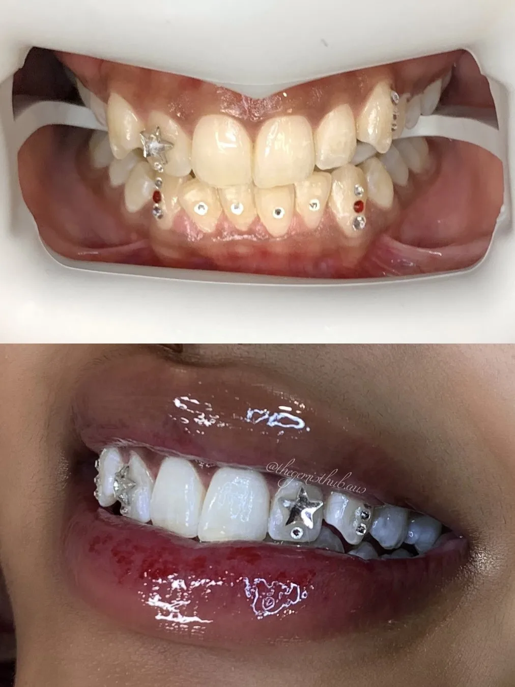 Before-and-after of a gem placement — the same smile, transformed