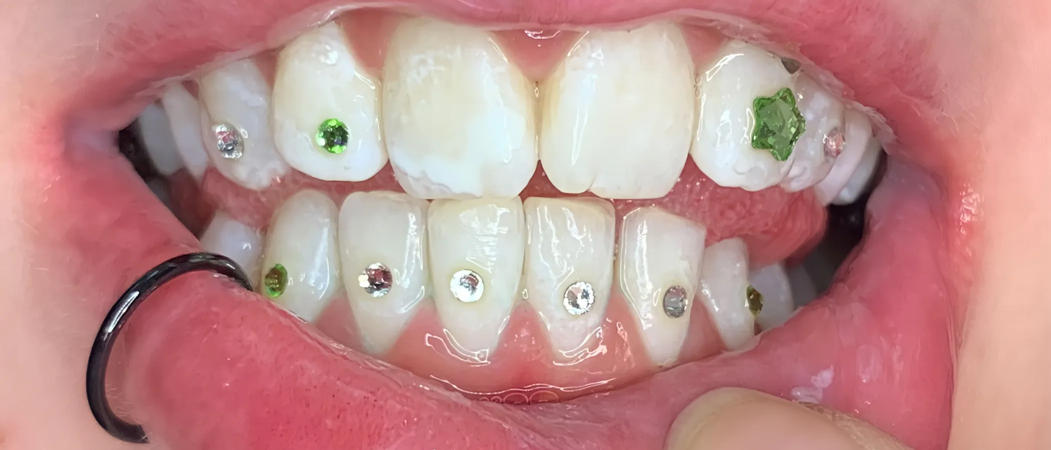 A wide set of coloured gems on a bright, even smile — the pairing whitening is designed for.