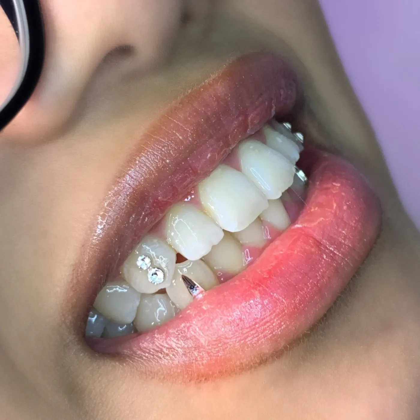 A client smiling with a crystal tooth gem set.