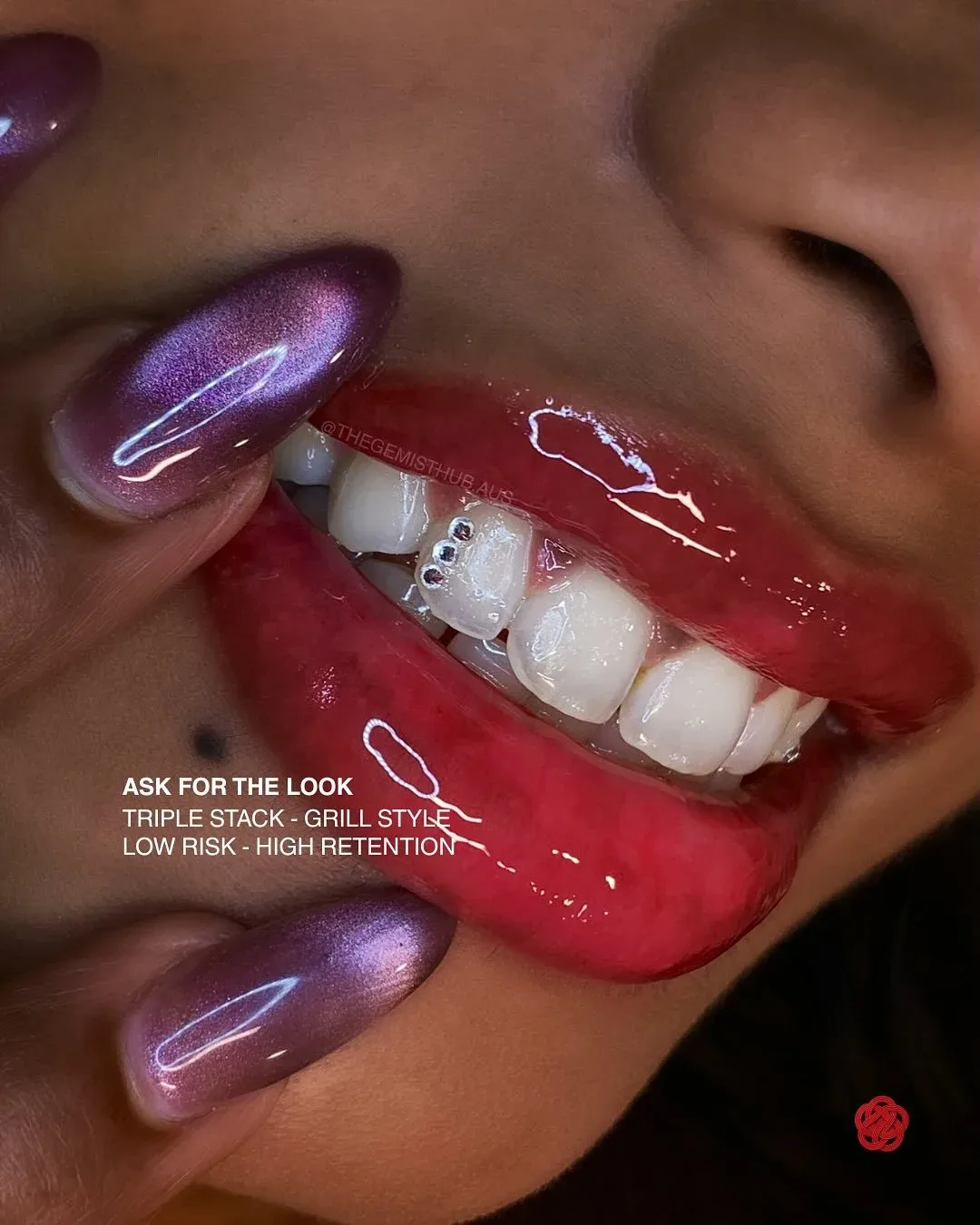 A full-smile tooth-gem placement — the signature of the work