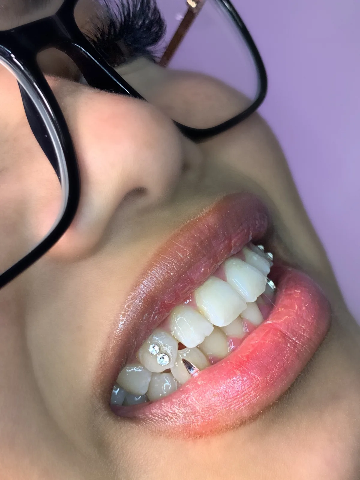 A tooth-gem placement photographed in side profile — the gem catching the light