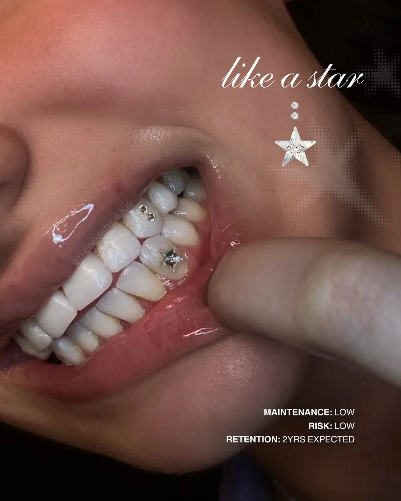 A single star gem placed on natural, uncut enamel.