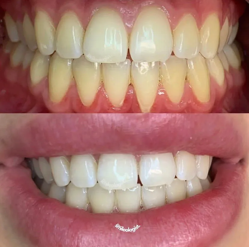 Before-and-after of a professional whitening session — a clean, even lift across the smile.